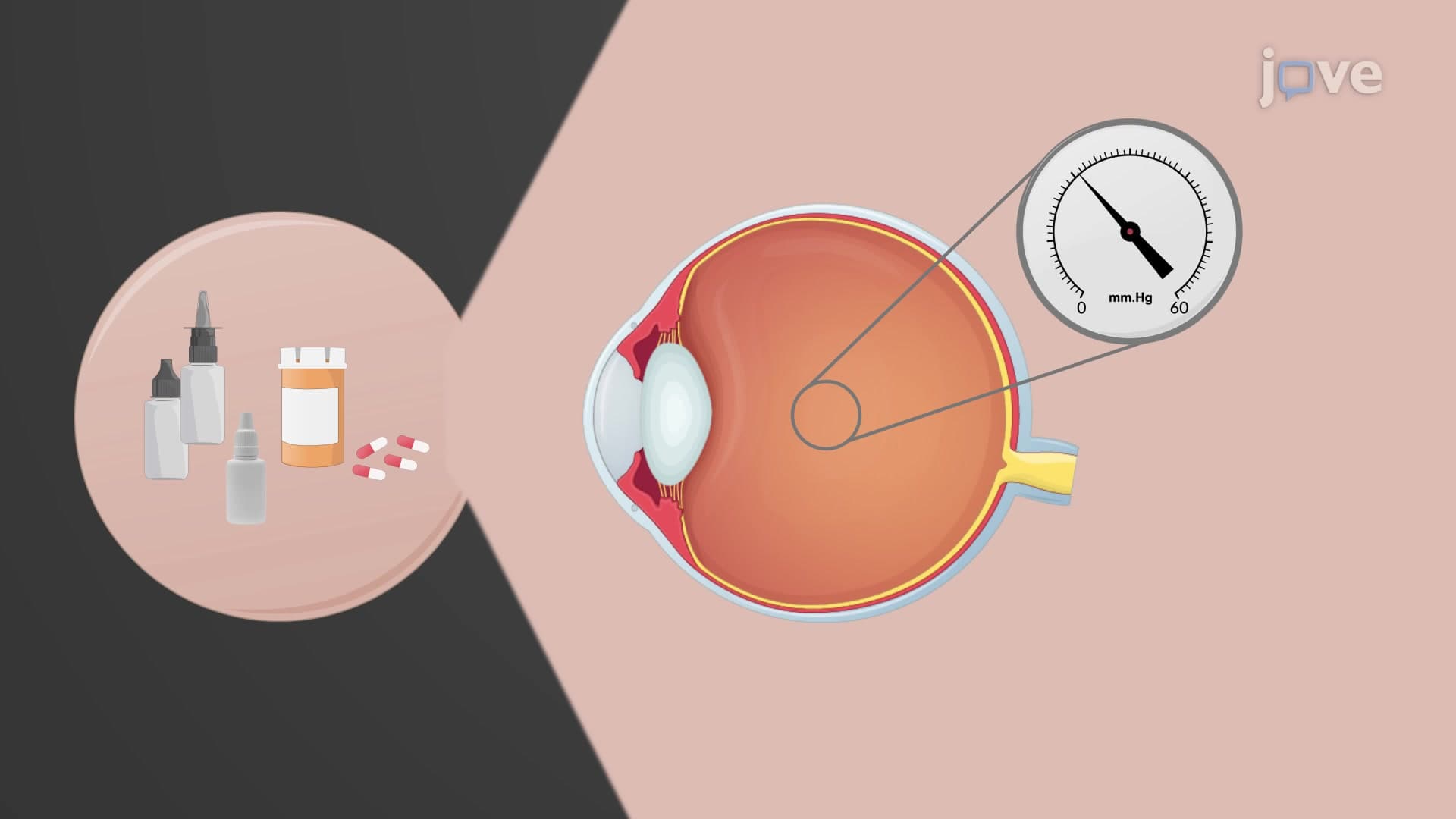 Angle Closure Glaucoma: Treatment
